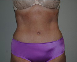 Vaser Liposuction Before & After Patient #259