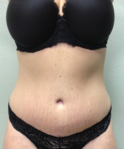 Vaser Liposuction Before & After Patient #259